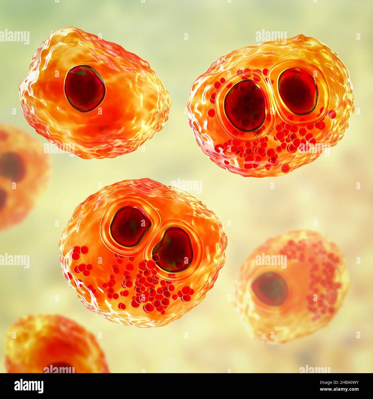 Citomegalovirus umani (HCMV) in una cellula che produce 'occhio del gufo' corpi di inclusione, illustrazione del calcolatore. Le cellule sono multinucleate con vacuolizzazione perinucleare. HCMV è un membro della famiglia degli herpesvirus. Ha un elevato tasso di infezione ed è una delle principali cause di malattia nei neonati vulnerabili e nei pazienti immunocompromessi, ma in genere non causa la malattia negli adulti sani. Foto Stock