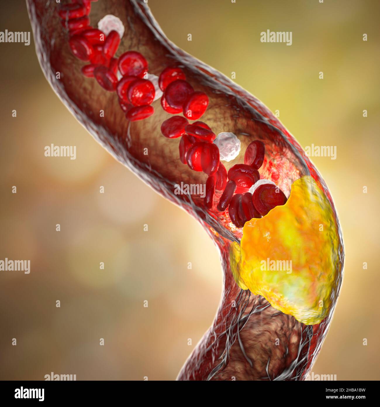 Aterosclerosi. Illustrazione che mostra una placca grassa (ateroma, giallo) sulla parete interna di un'arteria. Questa condizione, nota come aterosclerosi, è la causa più comune di restringimento arterioso. Foto Stock
