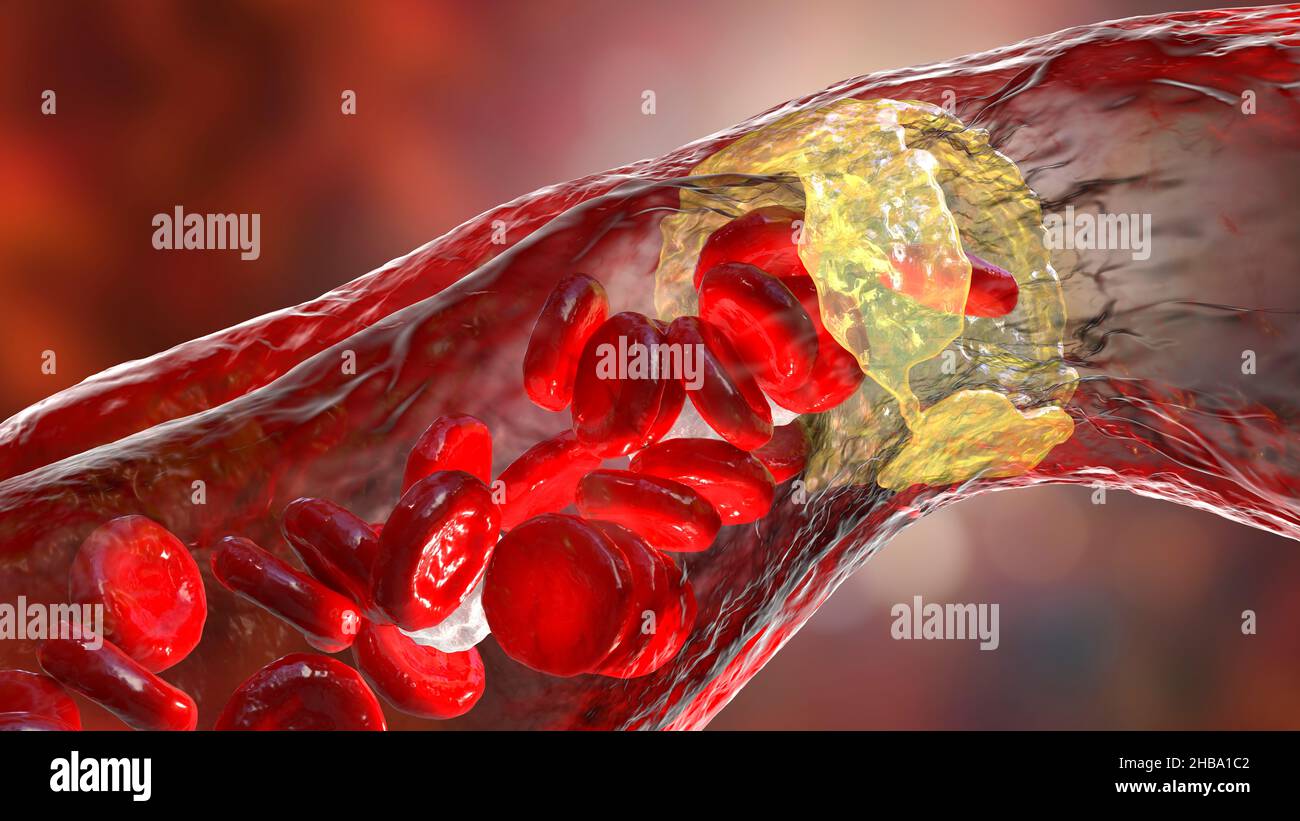 Aterosclerosi. Illustrazione che mostra una placca grassa (ateroma, giallo) sulla parete interna di un'arteria. Questa condizione, nota come aterosclerosi, è la causa più comune di restringimento arterioso. Foto Stock