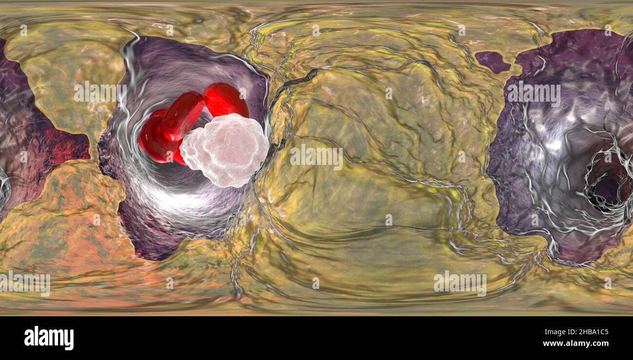 Aterosclerosi, vista panoramica a 360 gradi all'interno di un vaso sanguigno. Illustrazione che mostra una placca grassa (ateroma, giallo) sulla parete interna di un'arteria. Questa condizione, nota come aterosclerosi, è la causa più comune di restringimento arterioso. Foto Stock
