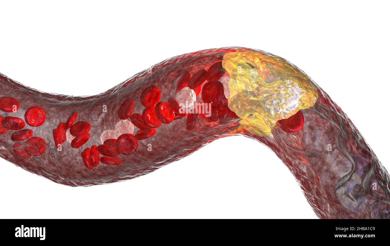 Aterosclerosi. Illustrazione che mostra una placca grassa (ateroma, giallo) sulla parete interna di un'arteria. Questa condizione, nota come aterosclerosi, è la causa più comune di restringimento arterioso. Foto Stock