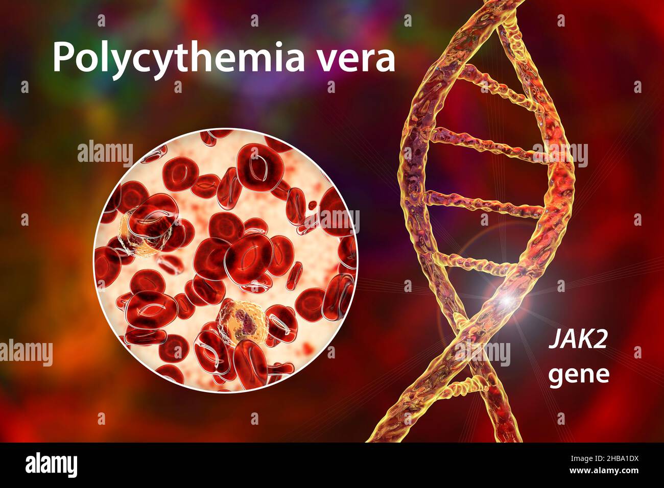 Illustrazione della policitemia vera, un raro tumore del sangue con un aumento del numero di globuli rossi nel corpo a causa della mutazione nel gene JAK2. Queste cellule in eccesso addensano il sangue, rallentandone il flusso. Inoltre causano le complicazioni, quali i coaguli di sangue, che possono condurre ad un attacco di cuore o ad un ictus. Senza trattamento, la policitemia vera può essere pericolosa per la vita. Le cure mediche possono aiutare a facilitare i segni, i sintomi e le complicazioni di questa malattia. Nel corso del tempo, in alcuni casi vi è il rischio di progredire verso tumori del sangue più gravi, come mielofibrosi o leucemia acuta. Foto Stock