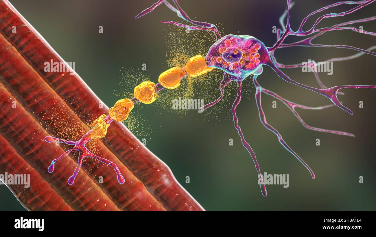 Neuroni nella malattia di Tay-Sachs. Illustrazione che mostra neuroni gonfi con inclusioni lamellari membranee dovute all'accumulo di gangliosidi nei lisosomi, degradazione della mielina. La malattia di Tay-Sachs è un disturbo che distrugge progressivamente i neuroni cerebrali, è causata da una mutazione nel gene HEXA del cromosoma 15 che porta alla deficienza di esosaminidasi A. Tay-sachs è più comunemente osservato nei bambini, manifestandosi nella debolezza muscolare e nella ridotta funzione motoria, perdita della vista e dell'udito, e invalidità intellettuale. Foto Stock
