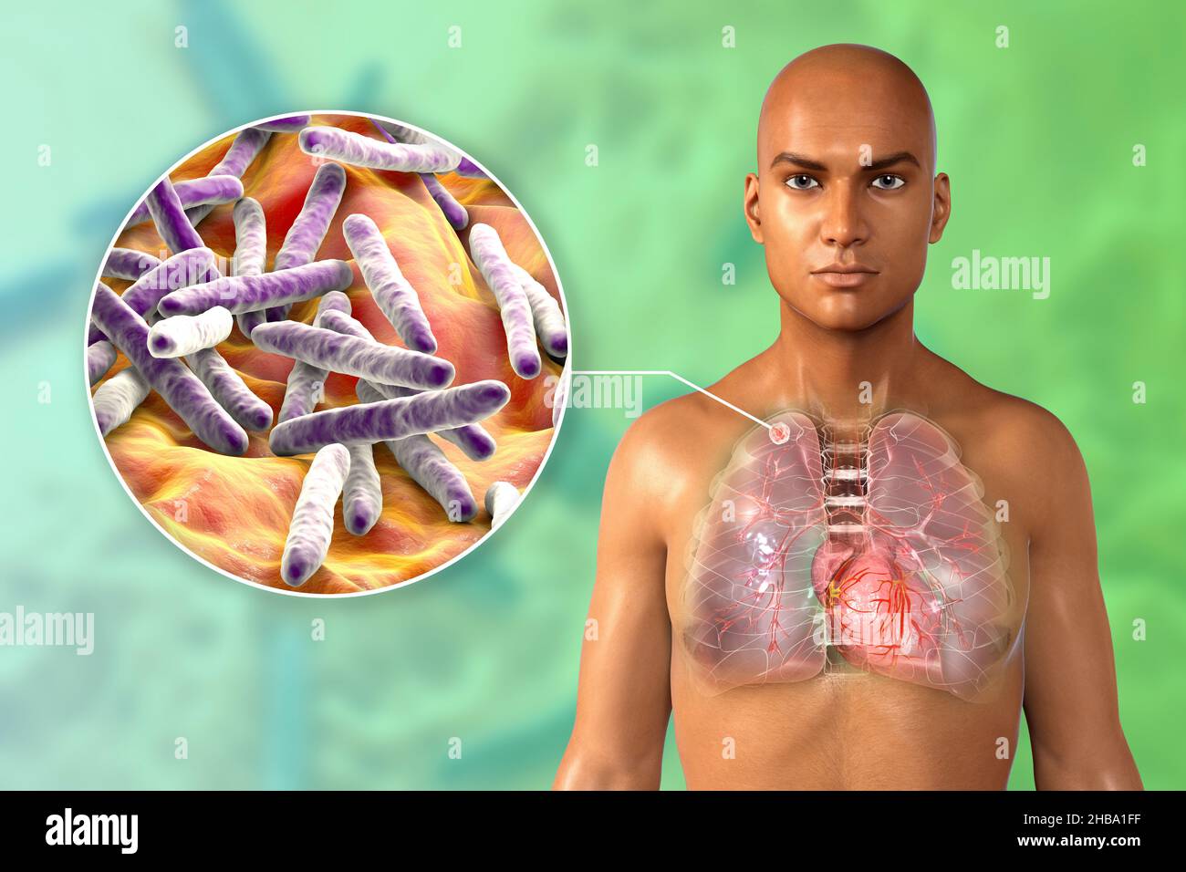 Illustrazione di un'infezione secondaria da tubercolosi e di una vista ravvicinata dei batteri Mycobacterium tuberculosis, l'agente causativo della tubercolosi. Nel lobo superiore del polmone destro, vicino all'apice del polmone, è presente una massa nodulare solida di piccole dimensioni. Foto Stock