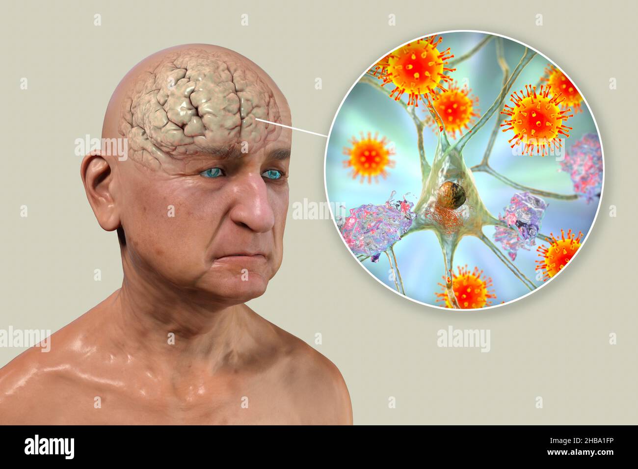 Eziologia infettiva della demenza. Illustrazione concettuale del computer che mostra una persona anziana con malattia di Alzheimer, menomazioni progressive delle funzioni cerebrali, placche amiloidi nel cervello, e virus che attaccano i neuroni. Foto Stock
