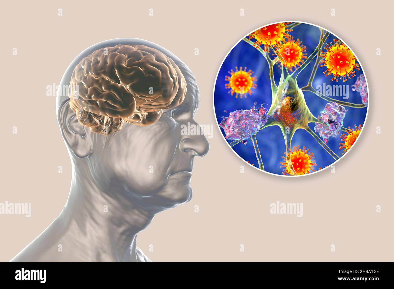 Eziologia infettiva della demenza. Illustrazione concettuale al computer di una persona anziana con il morbo di Alzheimer, menomazioni progressive delle funzioni cerebrali, placche amiloidi nel cervello, e virus che attaccano neuroni. Foto Stock