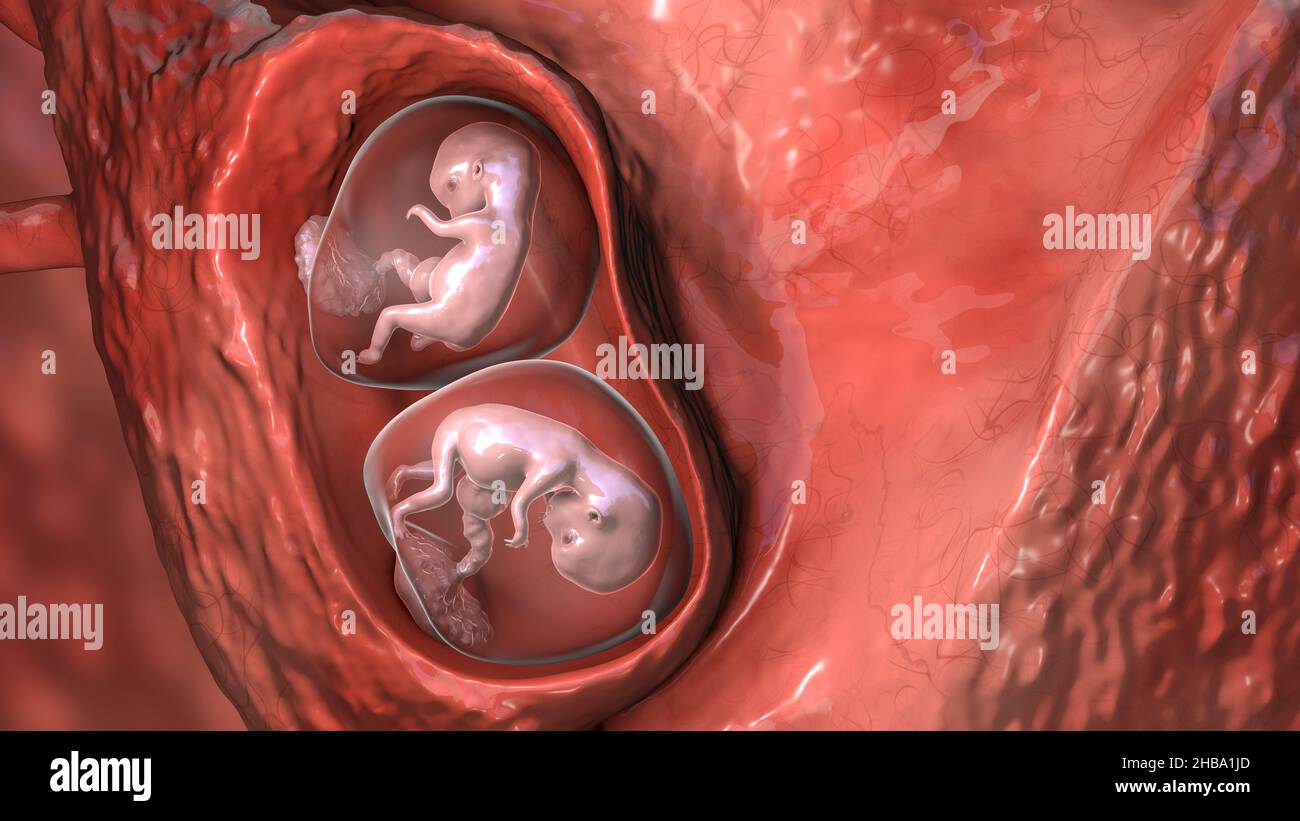 Gravidanza multipla, illustrazione. Gemelli monozigoti in utero che condividono la stessa placenta alla settimana 8. Foto Stock