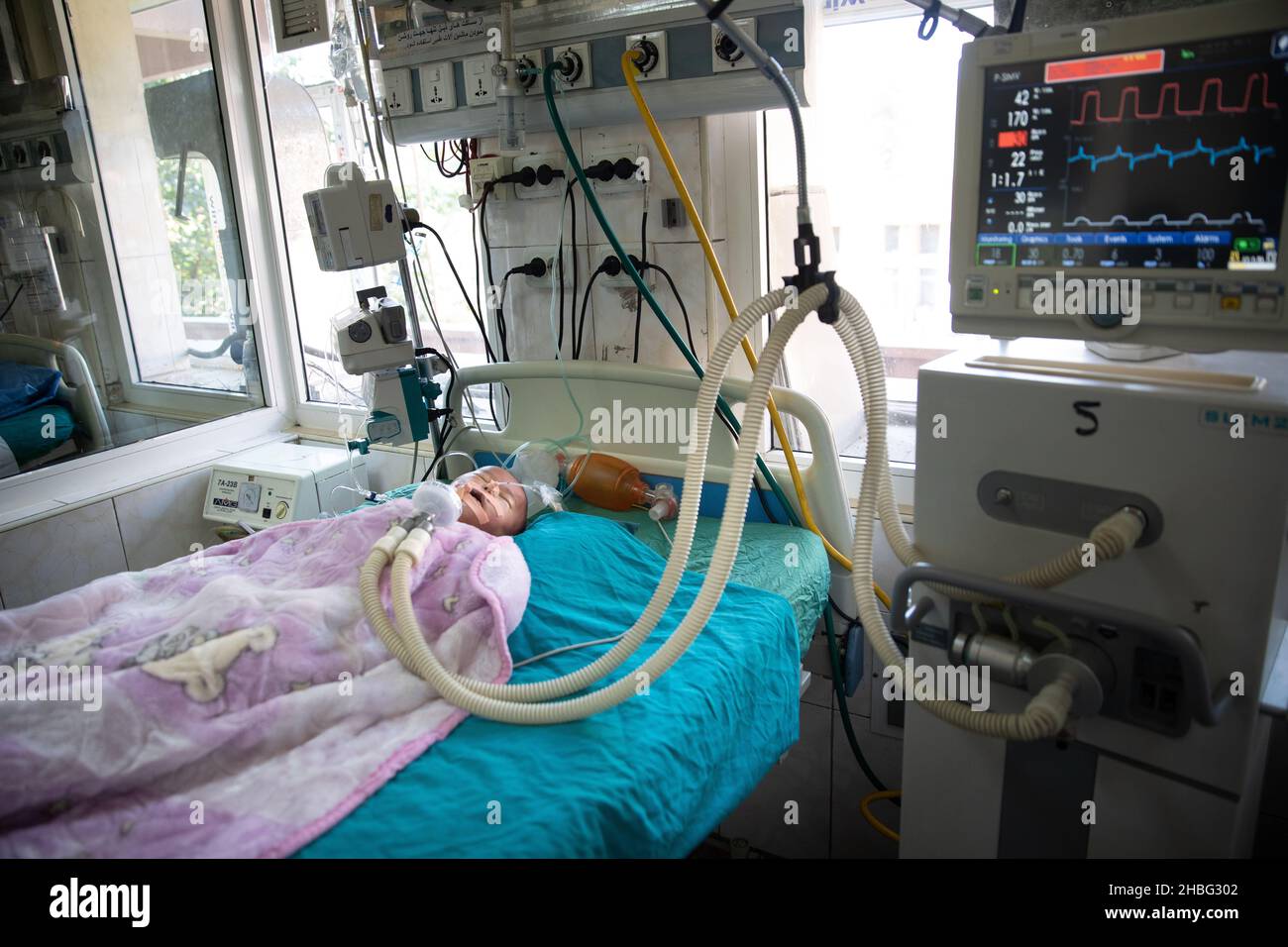 Indira Gandhi l'ospedale pediatrico di Kabul è un ospedale pediatrico dell'Afghanistan, i bambini sotto i 5 anni che soffrono di malnutrizione sono ricoverati in ospedale. Foto Stock