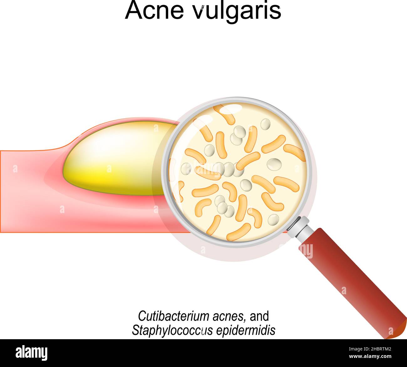 Primo piano di Acne vulgaris. Sezione trasversale di una pelle umana con pimple. Lente d'ingrandimento e batteri che causano l'acne. Cutibacterium acnes Illustrazione Vettoriale