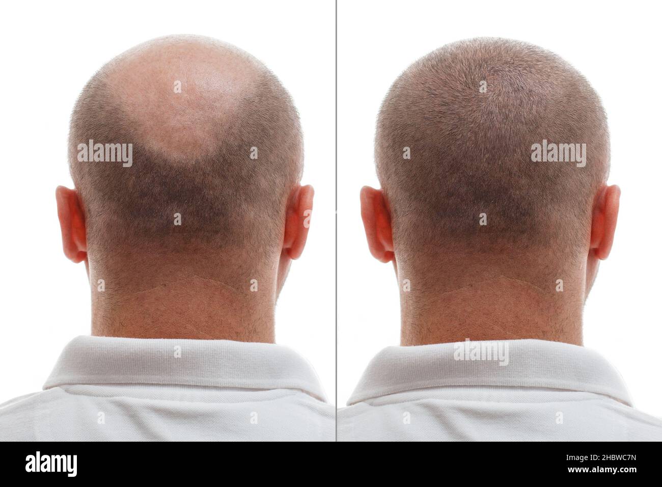La testa di un uomo balding prima e dopo l'intervento chirurgico di trapianto di capelli. Un uomo che perde i capelli è diventato timonoso. Un poster pubblicitario per i capelli Foto Stock