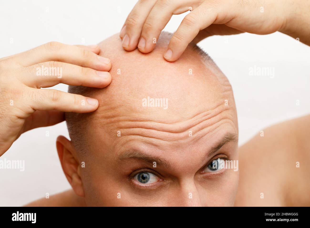 La testa di un baldante. Un uomo calvo era sconvolto a causa della perdita dei capelli. Trattamento della calvizie. Foto Stock