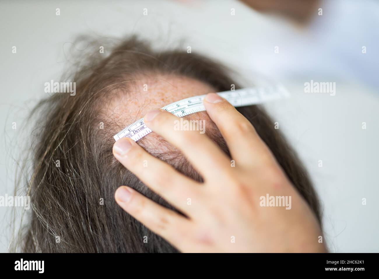 Primo piano delle mani della donna che lavorano per la preparazione del trapianto di capelli sulla testa dell'uomo Foto Stock