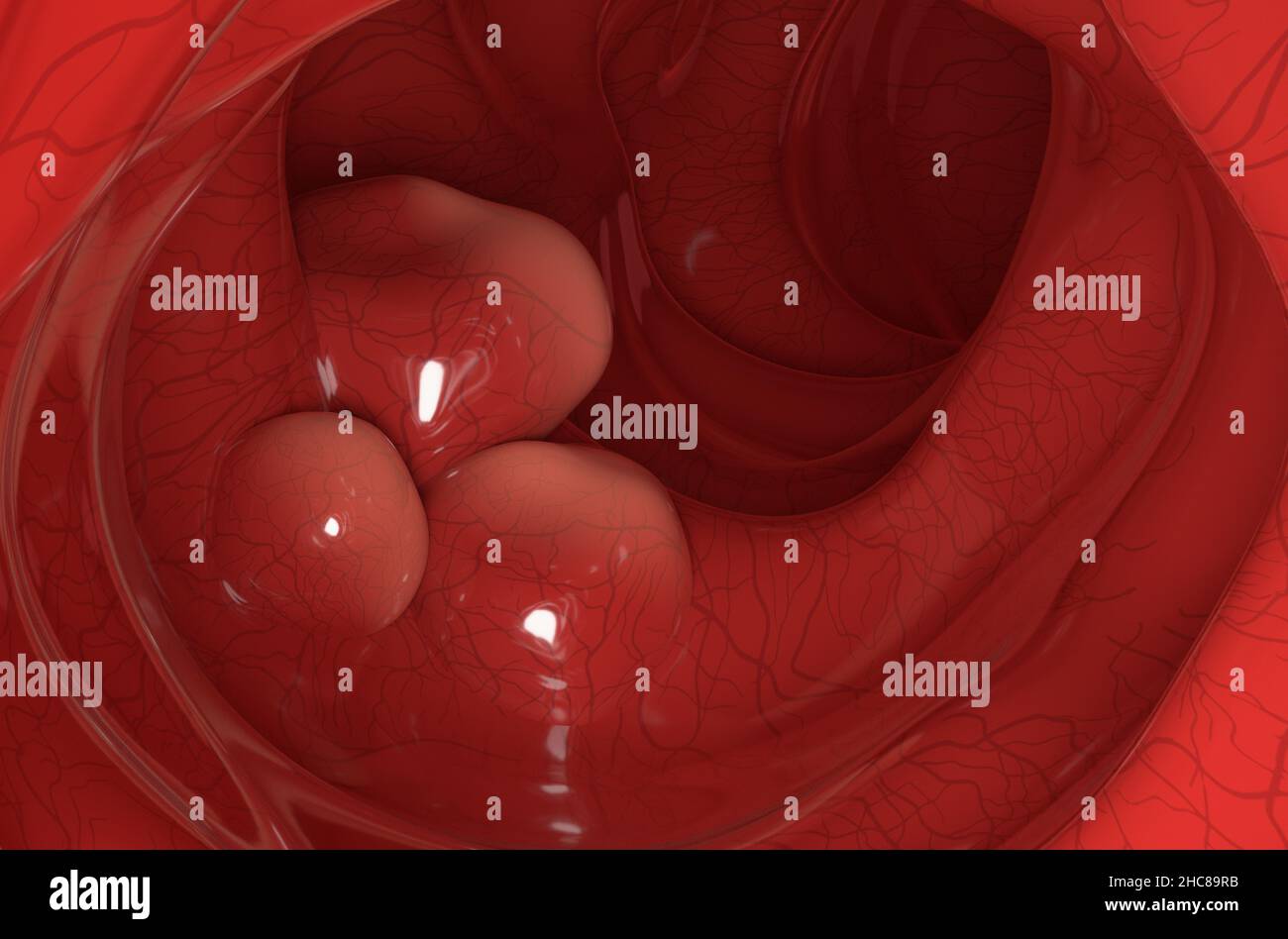 Tumori grandi sulla parete del colon in closeup cancro colorettale vista 3D illustrazione Foto Stock