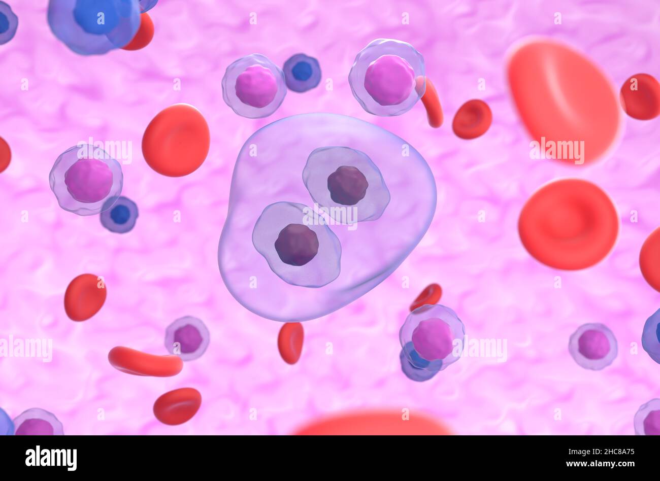 Figura di rappresentazione della cellula Reed-Sternberg in hodgkin linfoma isometrico 3D Foto Stock