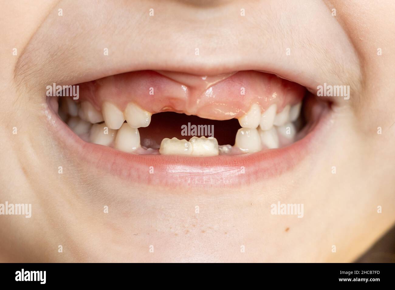 Primo piano di una ragazza di 6-7 anni con denti in eruzione. Perdita dei denti del latte. Dentizione nuova Foto Stock