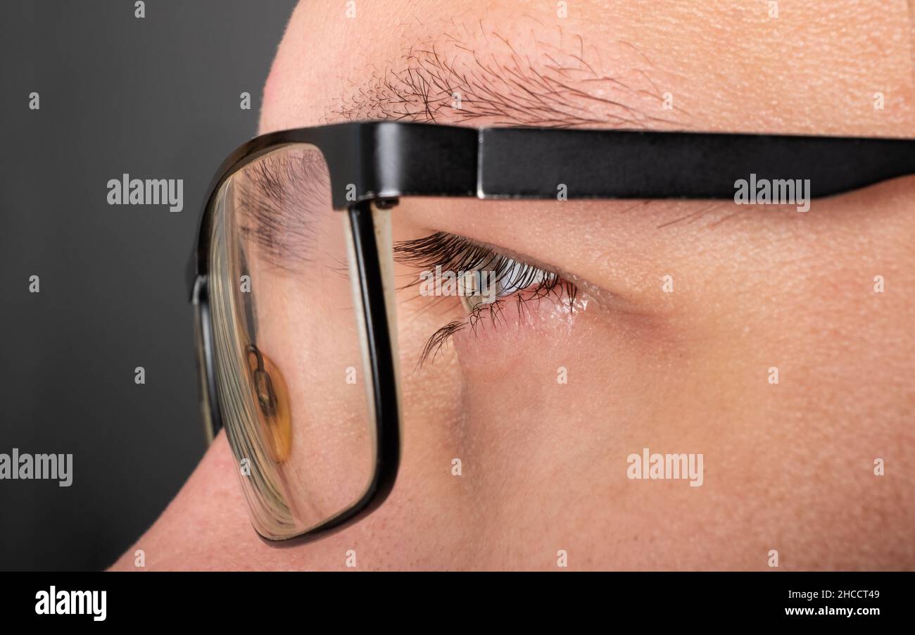 ragazza con la vista povera con gli occhiali, astigmatismo miopia Foto  stock - Alamy