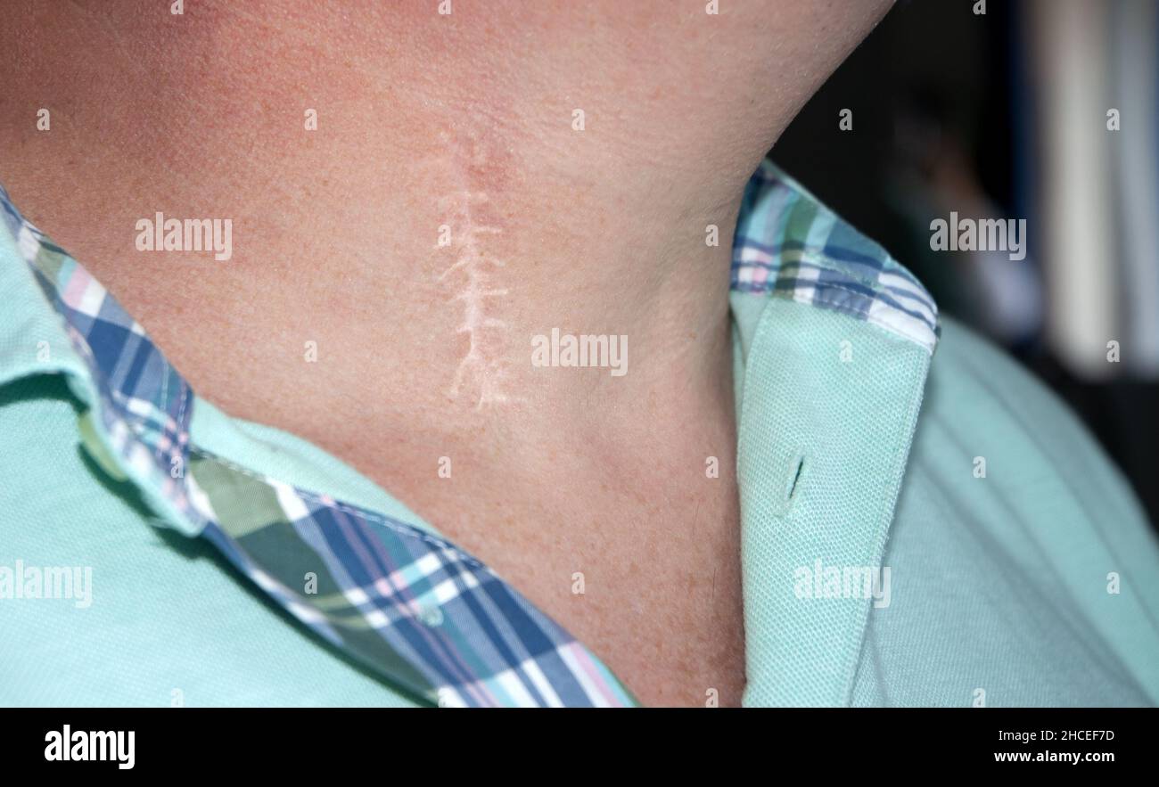 Cicatrice lasciata sul collo dopo un intervento chirurgico di un'erniazione del disco cervicale Foto Stock