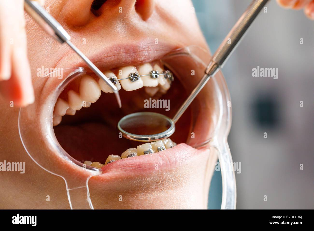 Una giovane donna con bretelle metalliche viene esaminata da un ortodontista. Correzione del morso dei denti nella clinica dentale. Concetto di denti sani Foto Stock