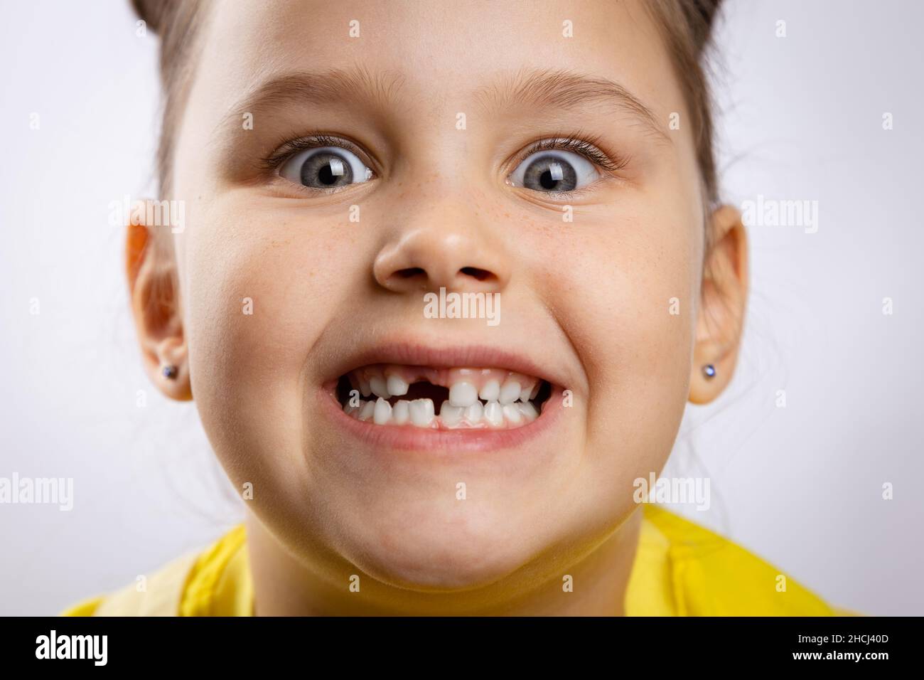 Primo piano di super eccitato femmina capretto con bocca aperta che mostra mancante dente del bambino anteriore e occhi gonfianti su sfondo bianco. Sostituzione dei primi denti Foto Stock