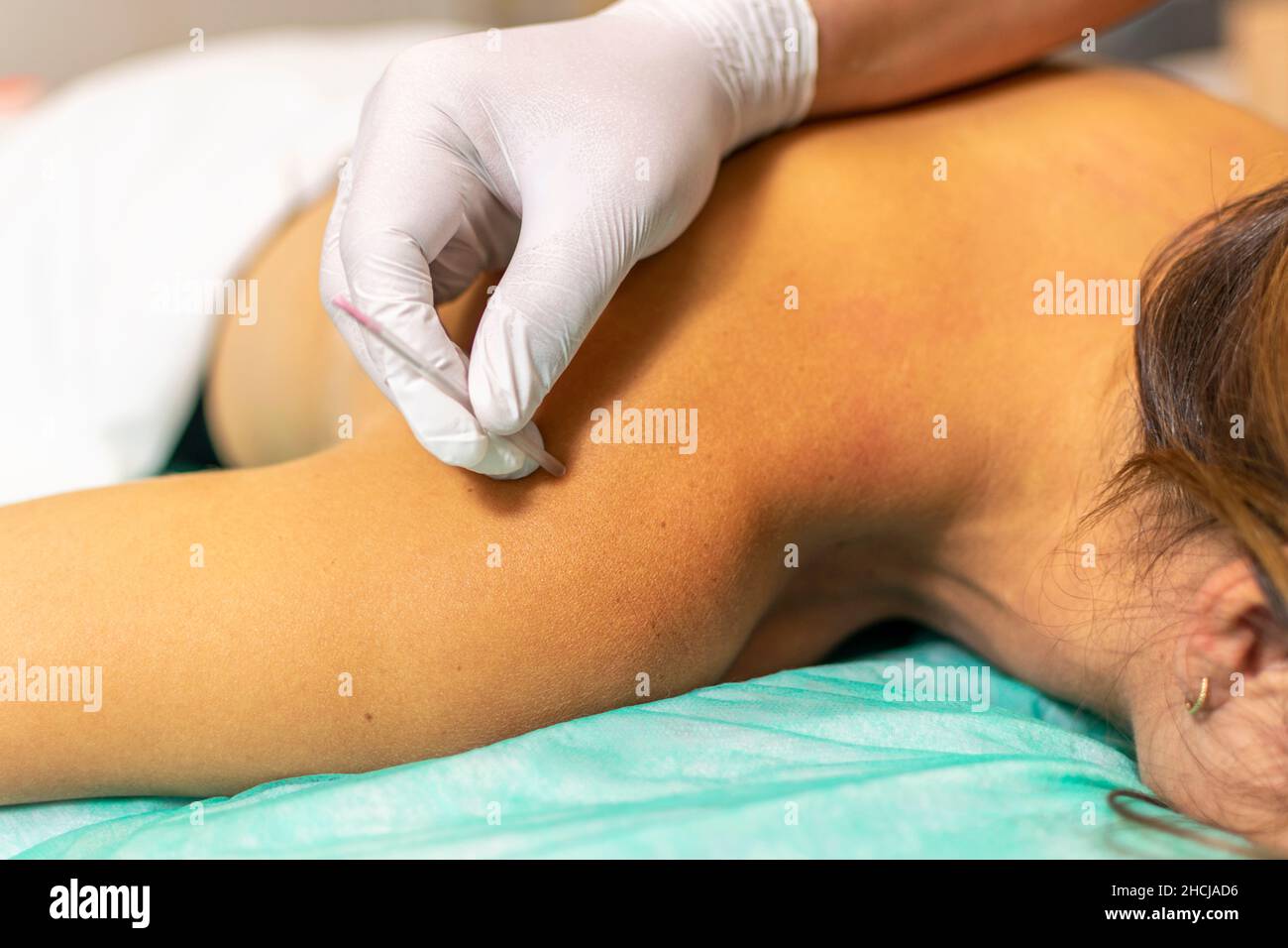 Particolare della giovane donna caucasica che riceve un trattamento di agugliatura a secco. Messa a fuoco selettiva Foto Stock
