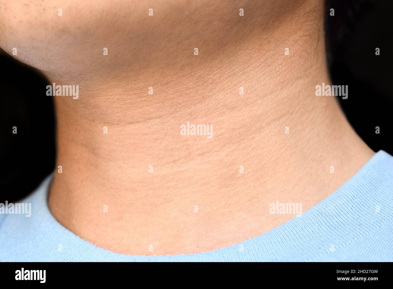 Invecchiamento della pelle pieghe o pieghe della pelle o rughe al collo del sud-est asiatico, cinese giovane uomo. Foto Stock