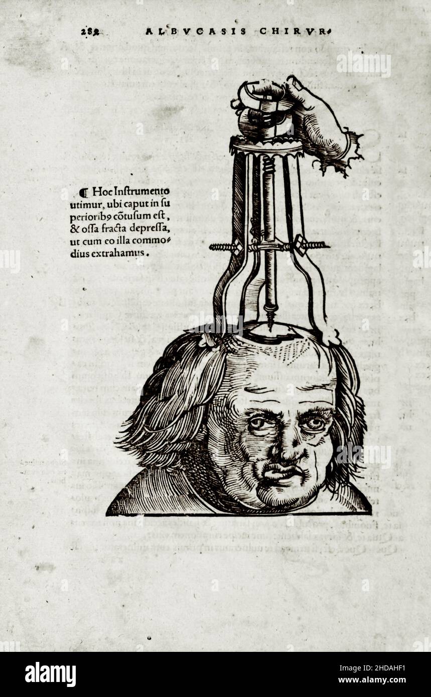 L'illustrazione di 16th secolo di chirurgia e interventi chirurgici nel Medioevo: Trepanation del cranio. Dai libri medievali di Octavius ho Foto Stock