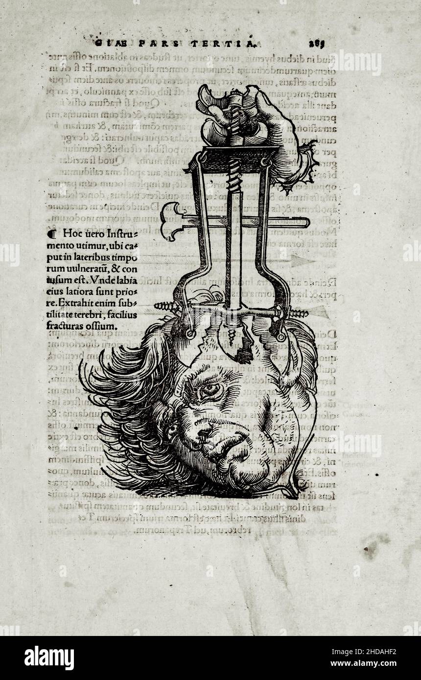 L'illustrazione di 16th secolo di chirurgia e interventi chirurgici nel Medioevo: Trepanation del cranio. Dai libri medievali di Octavius ho Foto Stock