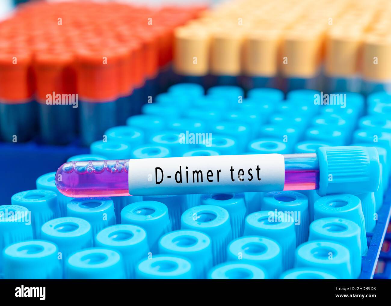 Provetta per analisi del sangue per test D-dimer, diagnosi di trombosi intravascolare dopo COVID-19 Foto Stock