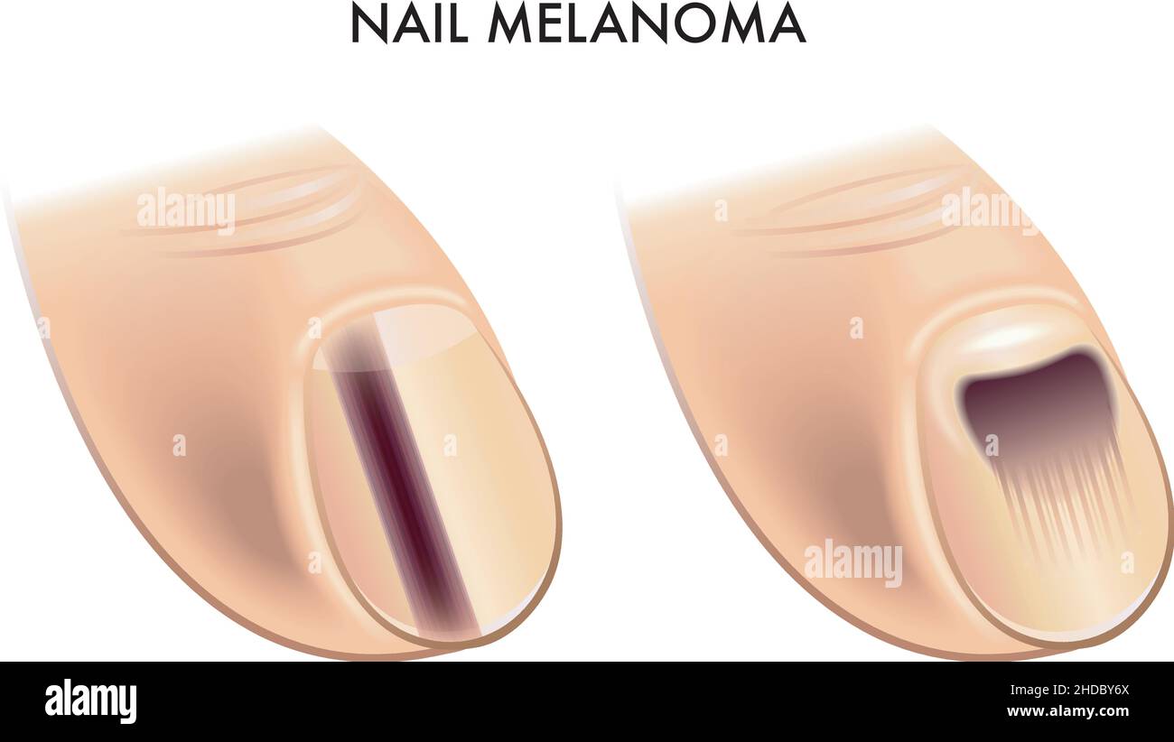 Illustrazione medica di due sintomi di melanoma delle unghie. Illustrazione Vettoriale