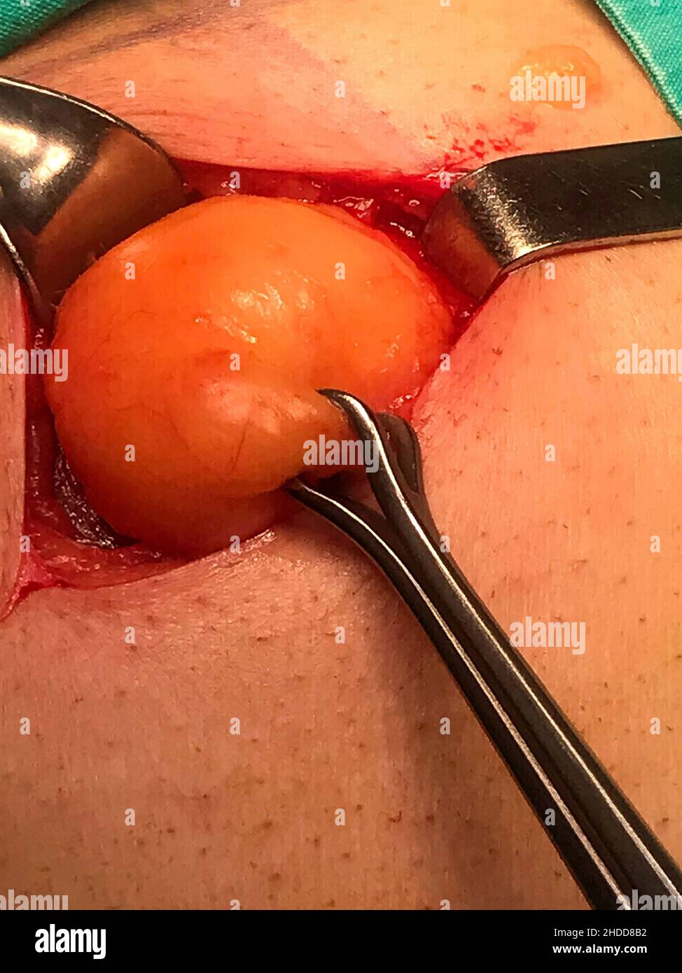 Chirurgia della ghiandola sebacea umana in età adulta. BLACKWHITE - 'ELECTİVE FOCUS' Foto Stock