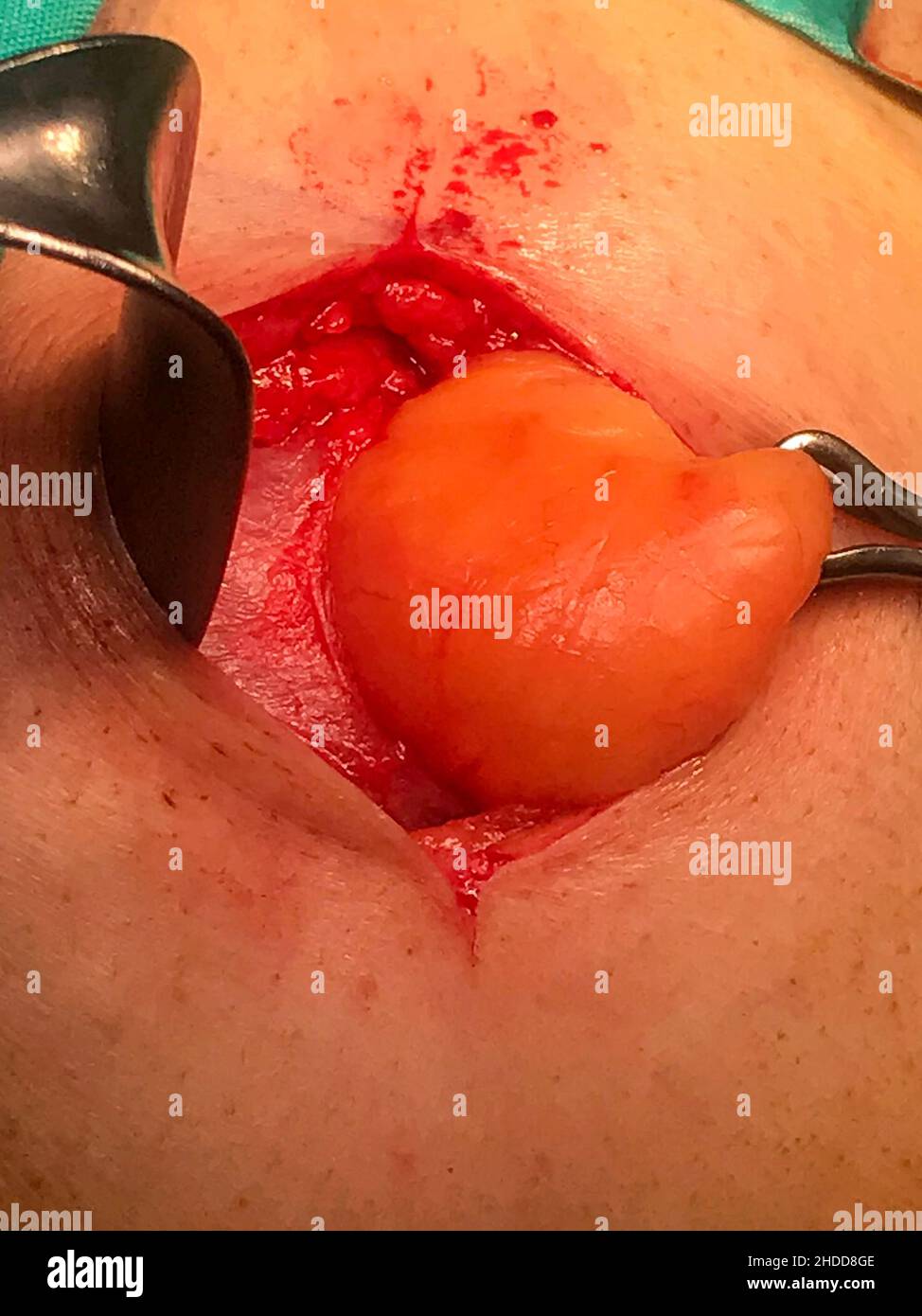 Chirurgia della ghiandola sebacea umana in età adulta. BLACKWHITE - 'ELECTİVE FOCUS' Foto Stock