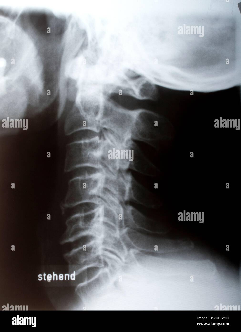 immagine radiologica, lesione, colonna vertebrale umana, colonna cervicale, radiologia, raggi x, raggi x, raggi x, lesioni, spine umane, spine cervicali Foto Stock