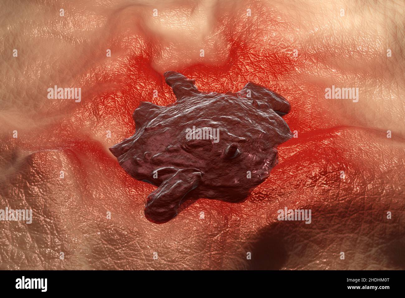 pelle, tumore, melanoma, pelle, tumori Foto Stock