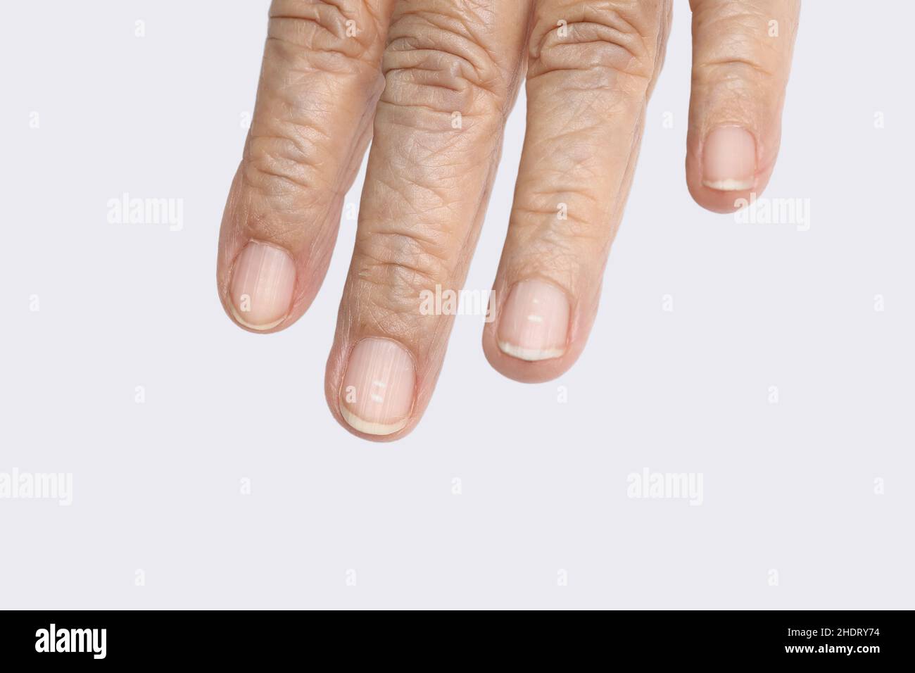 Macchie bianche sulle unghie anziane causate da una carenza di calcio Foto  stock - Alamy