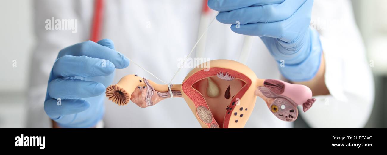 Il ginecologo mostra come legare i tubi di Falloppio sul modello di addestramento del sistema riproduttivo femminile Foto Stock