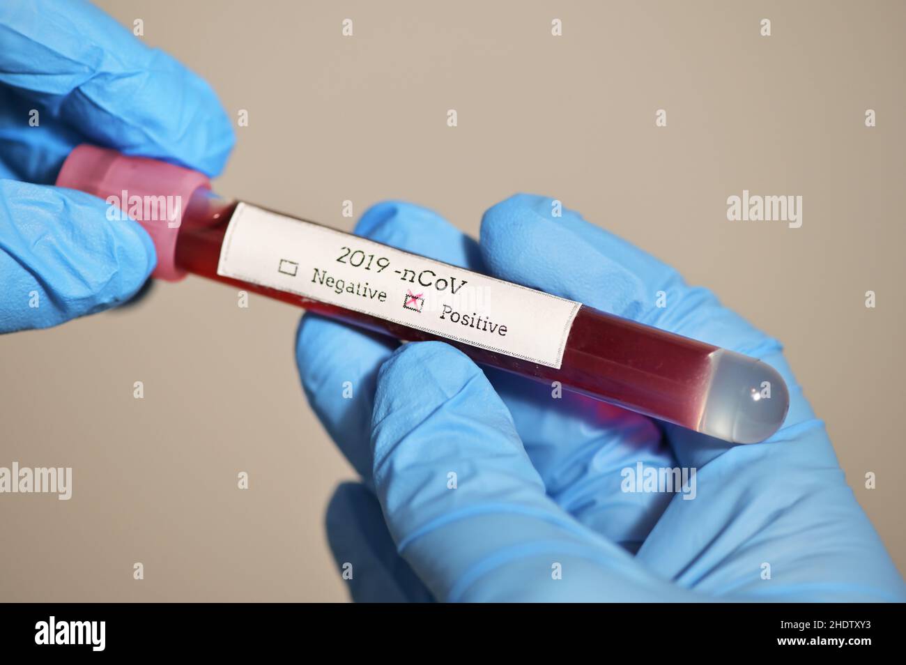 positivo, campione di sangue, corona virus, positivi, campioni di sangue Foto Stock