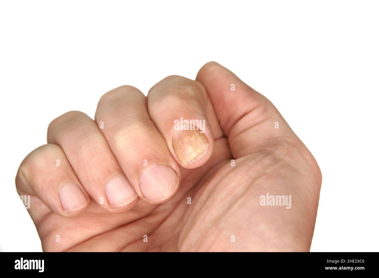Campione di funghi unghie su un dito della mano. Un esempio di salute delle unghie e della pelle. L'immagine del palmo singolo è su uno sfondo bianco chiaro. Foto Stock
