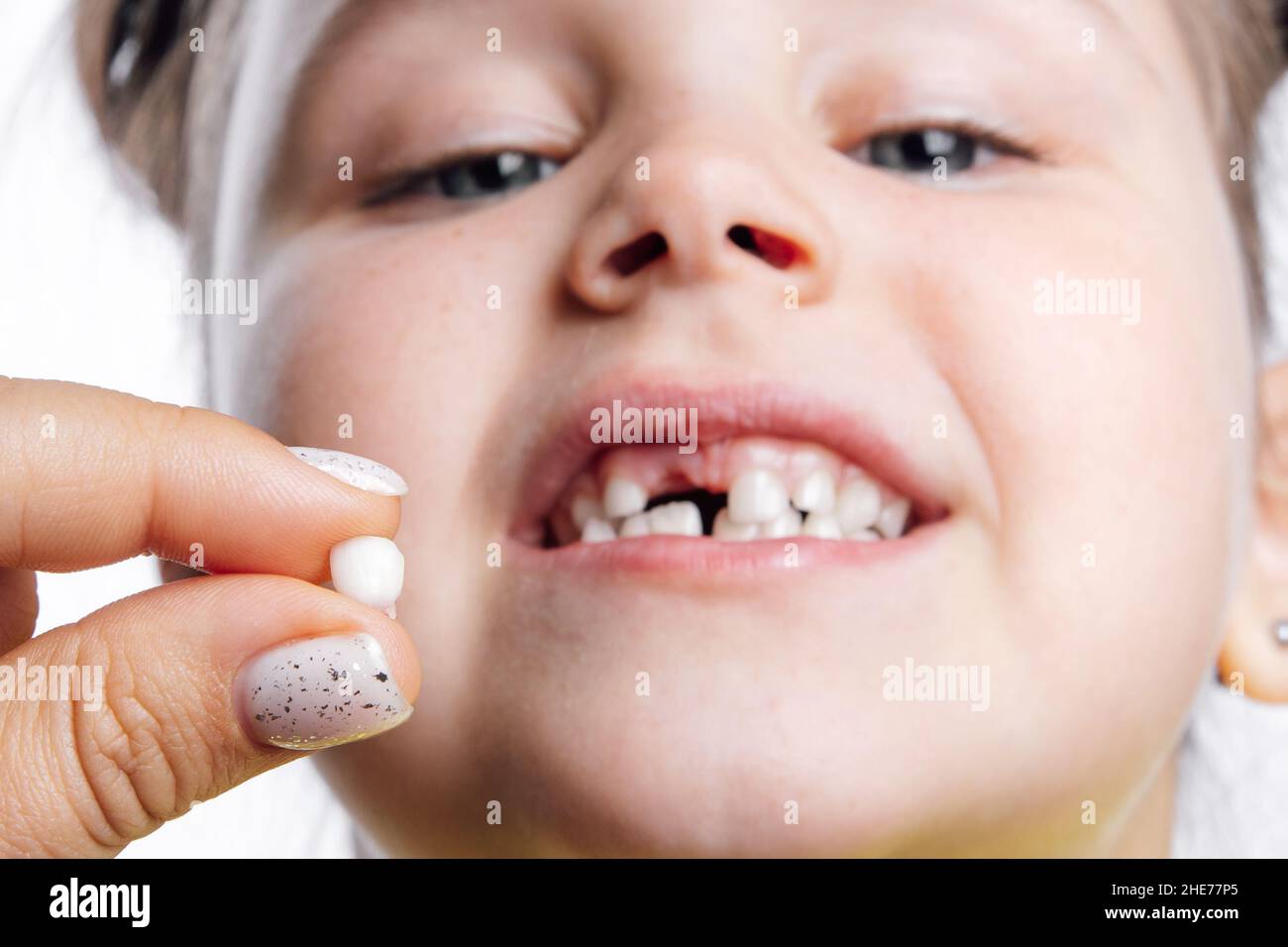 Due dita che tengono strappato il dente del latte davanti alla faccia della bambina guardando verso il basso la fotocamera, mostrando i denti dietro su sfondo bianco. Primi denti Foto Stock