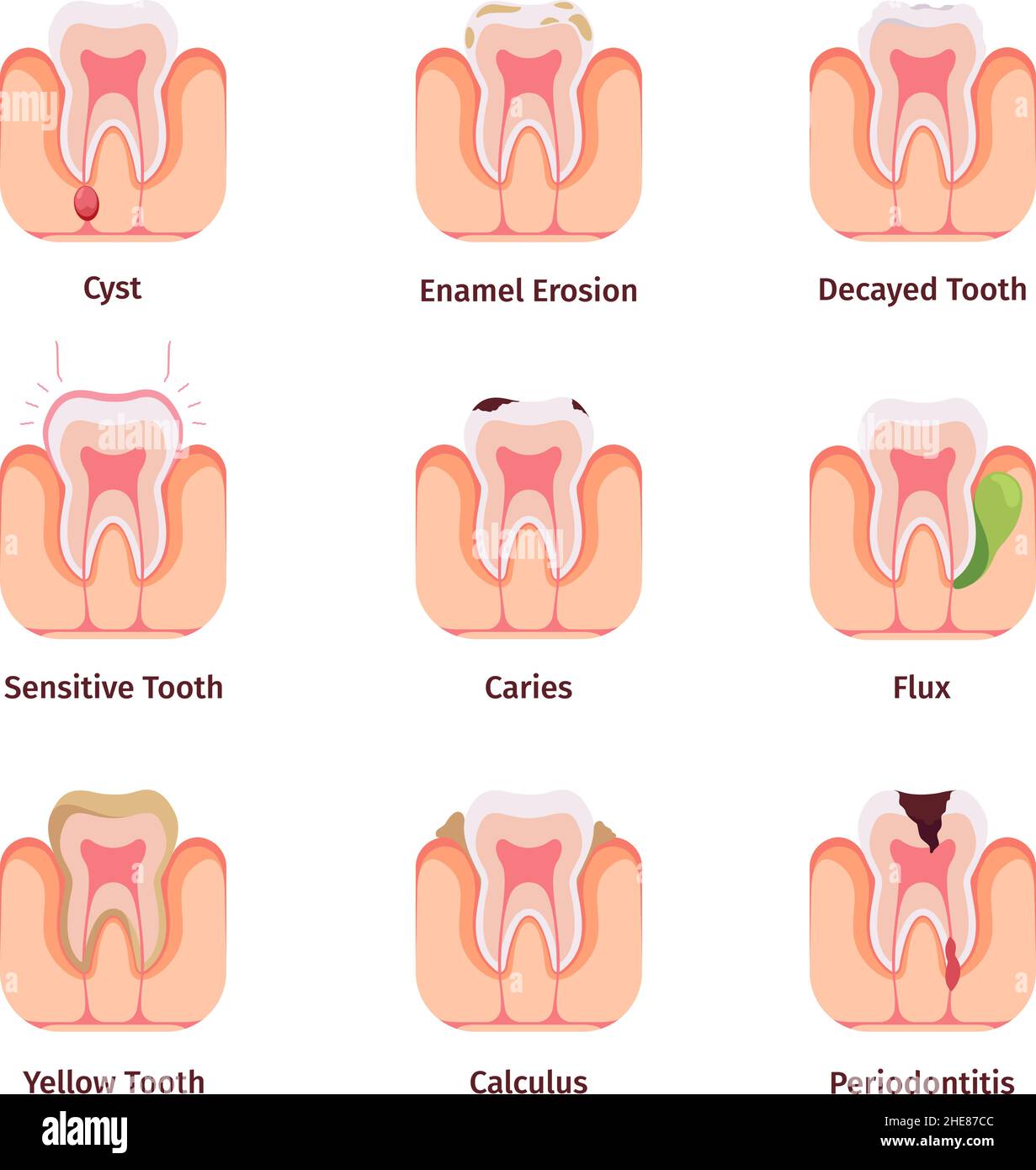 Problemi dentali. Disegni di denti di batteri orali differenti malfunzionante comune riempimenti guarish vettore infografica medica concetto illustrazioni Illustrazione Vettoriale