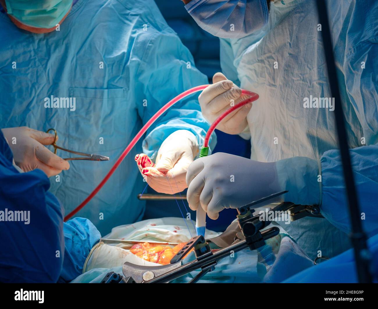 Primo piano delle mani dei chirurghi con guanti che pompano il sangue con un catetere durante l'intervento chirurgico. Messa a fuoco selettiva. Mani sanguinarie di medici in guanti sterili. Foto Stock