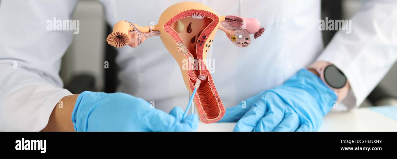 Ginecologo tiene modello di sistema riproduttivo femminile e spazzola citologica Foto Stock