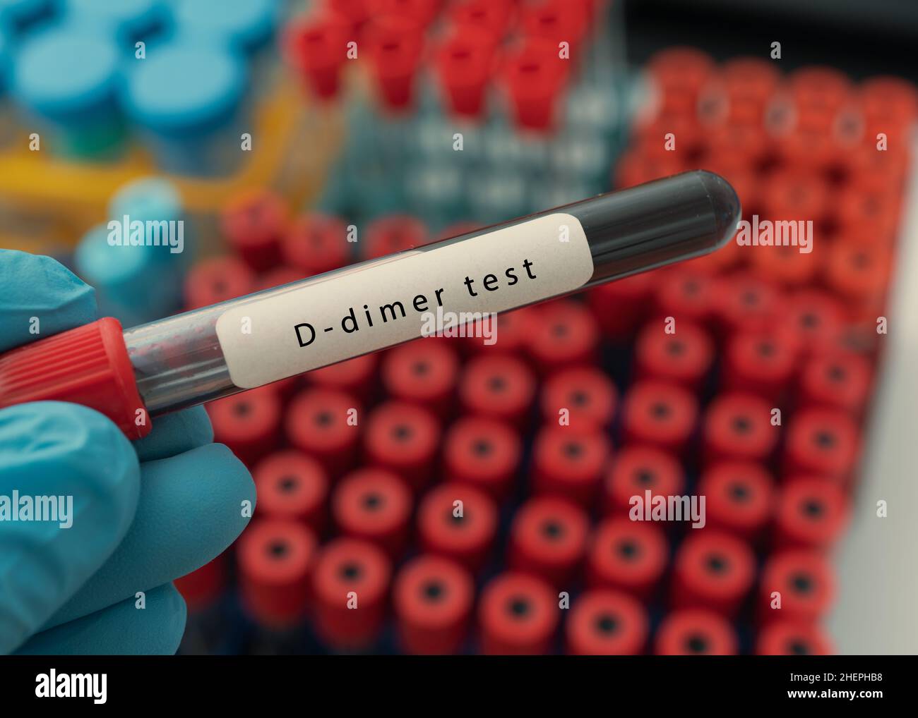 Provetta per analisi del sangue per test D-dimer, diagnosi di trombosi intravascolare dopo COVID-19 Foto Stock