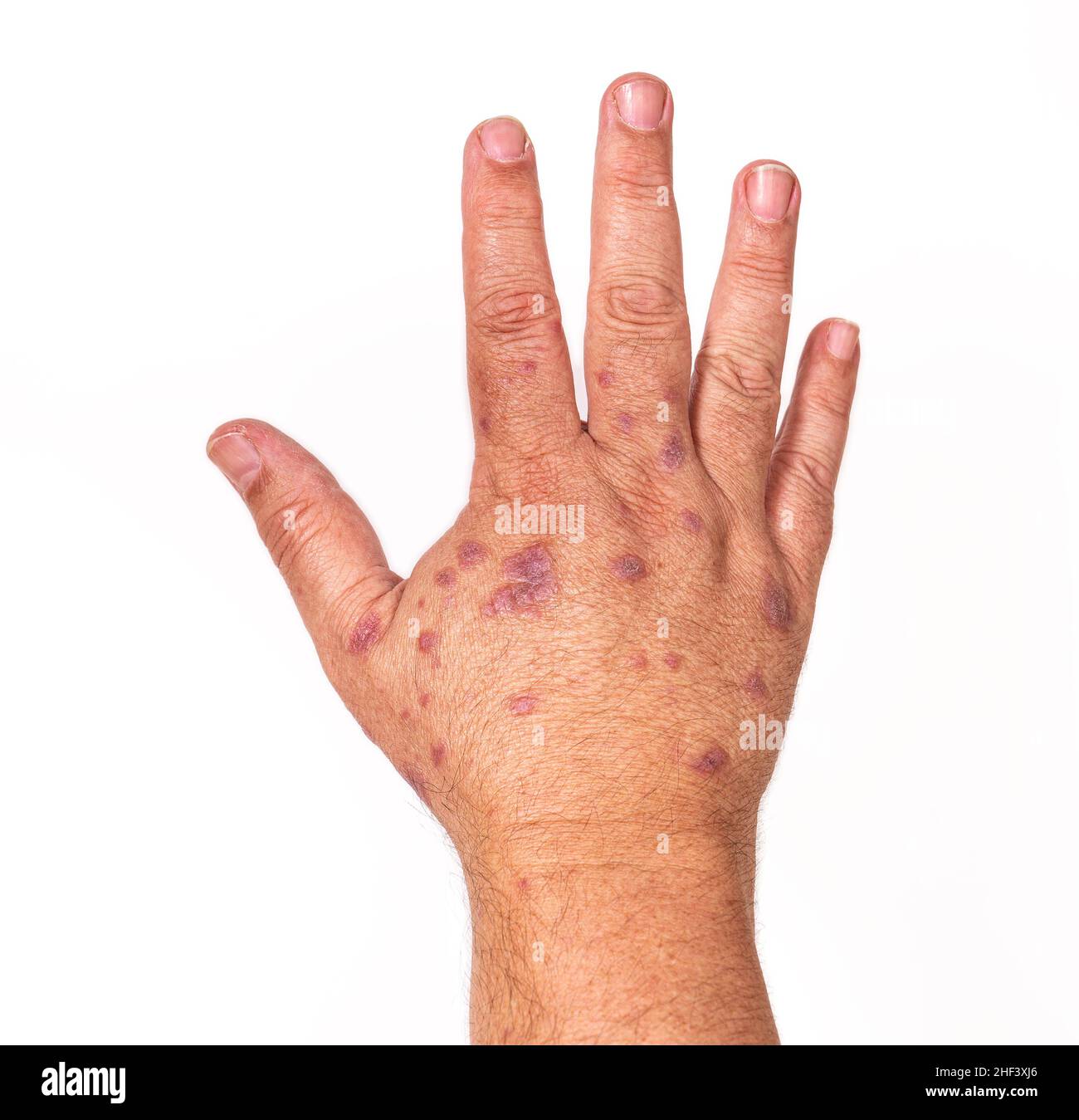 Dermatite allergica sulla pelle delle mani al vaccino o al medicinale.  Concetto di salute, cura della pelle. Sfondo bianco. Lato destro Foto stock  - Alamy