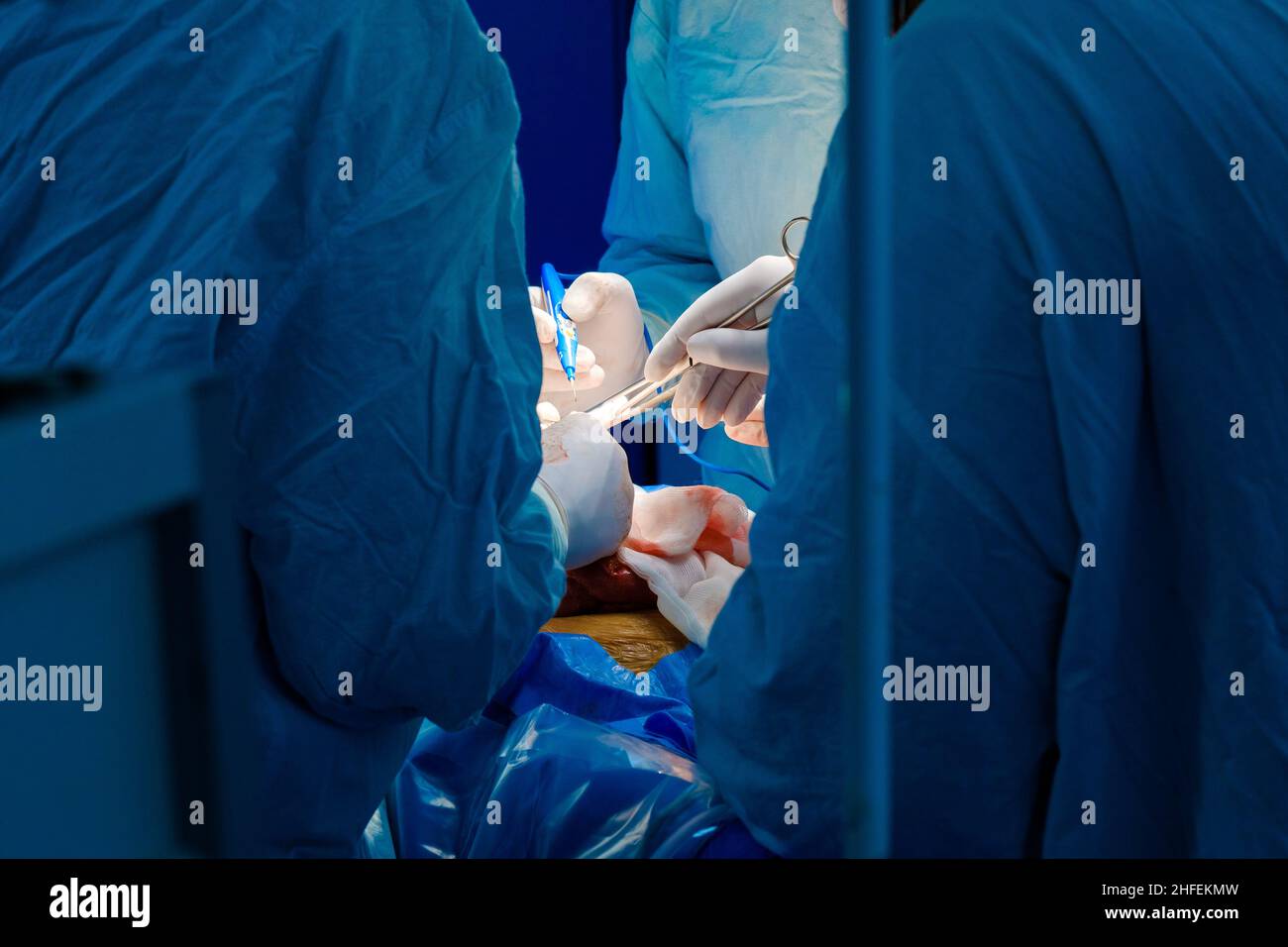 Mani di chirurghi con strumenti chirurgici durante un intervento chirurgico. Messa a fuoco selettiva. Foto Stock