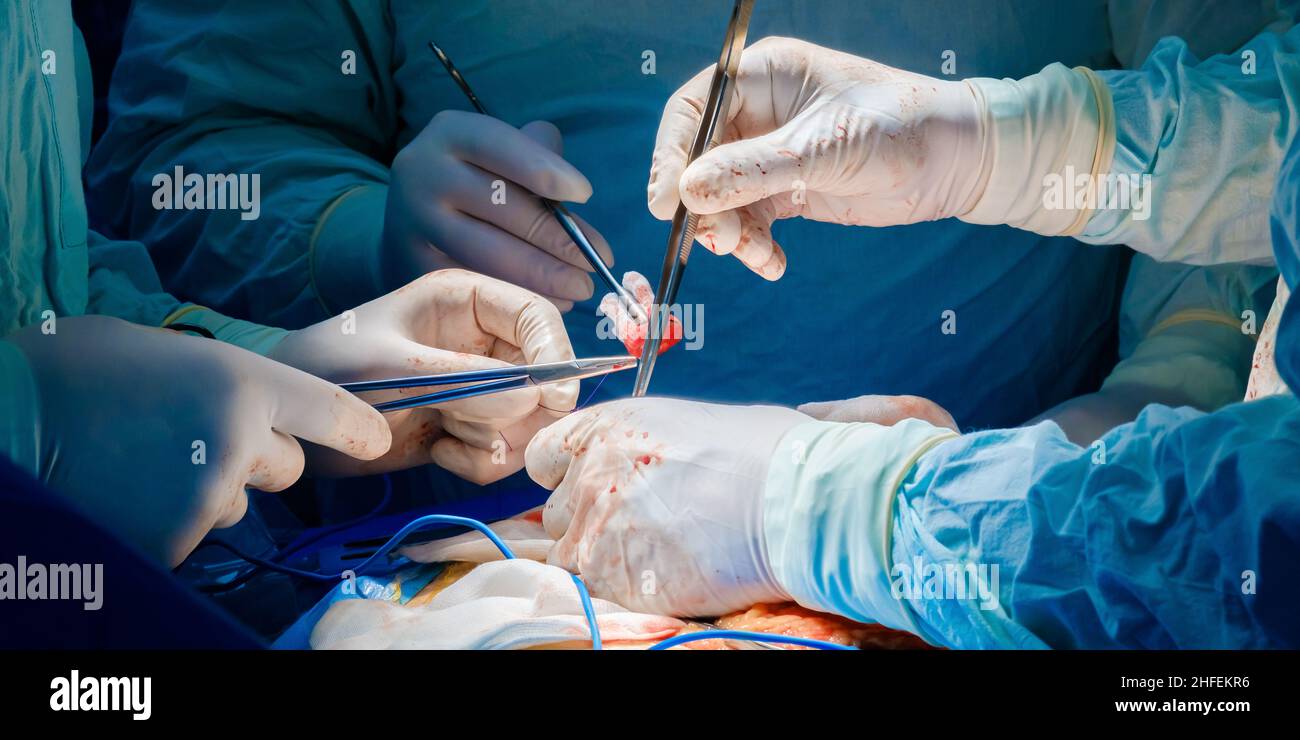 Un team di chirurghi professionisti opera su un paziente con strumenti medici. Messa a fuoco selettiva. Le mani dei medici durante un intervento chirurgico. Foto Stock