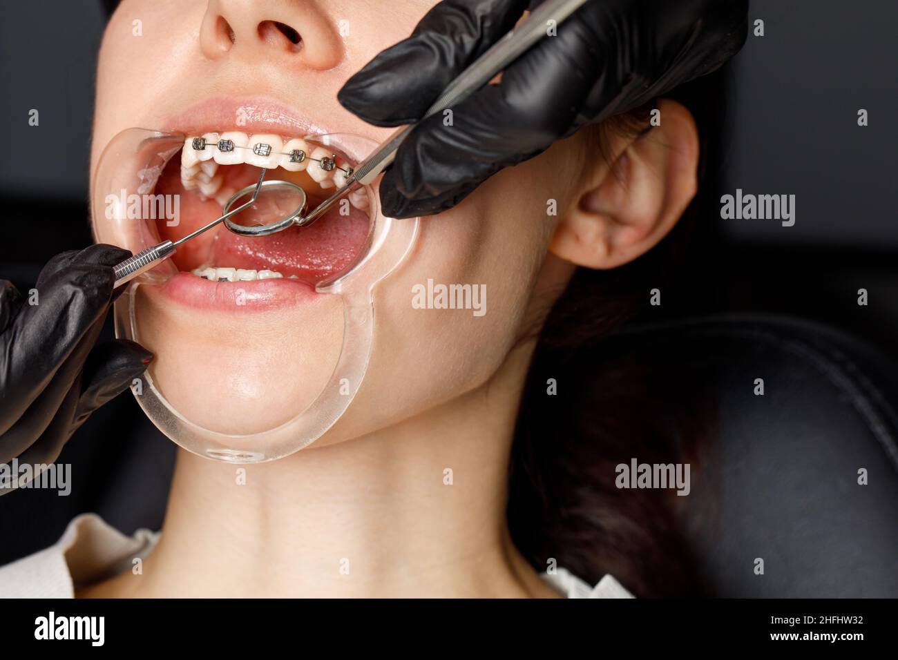 Una giovane donna con bretelle metalliche viene esaminata da un ortodontista. Correzione del morso dei denti nella clinica dentale. Concetto di denti sani. Foto Stock