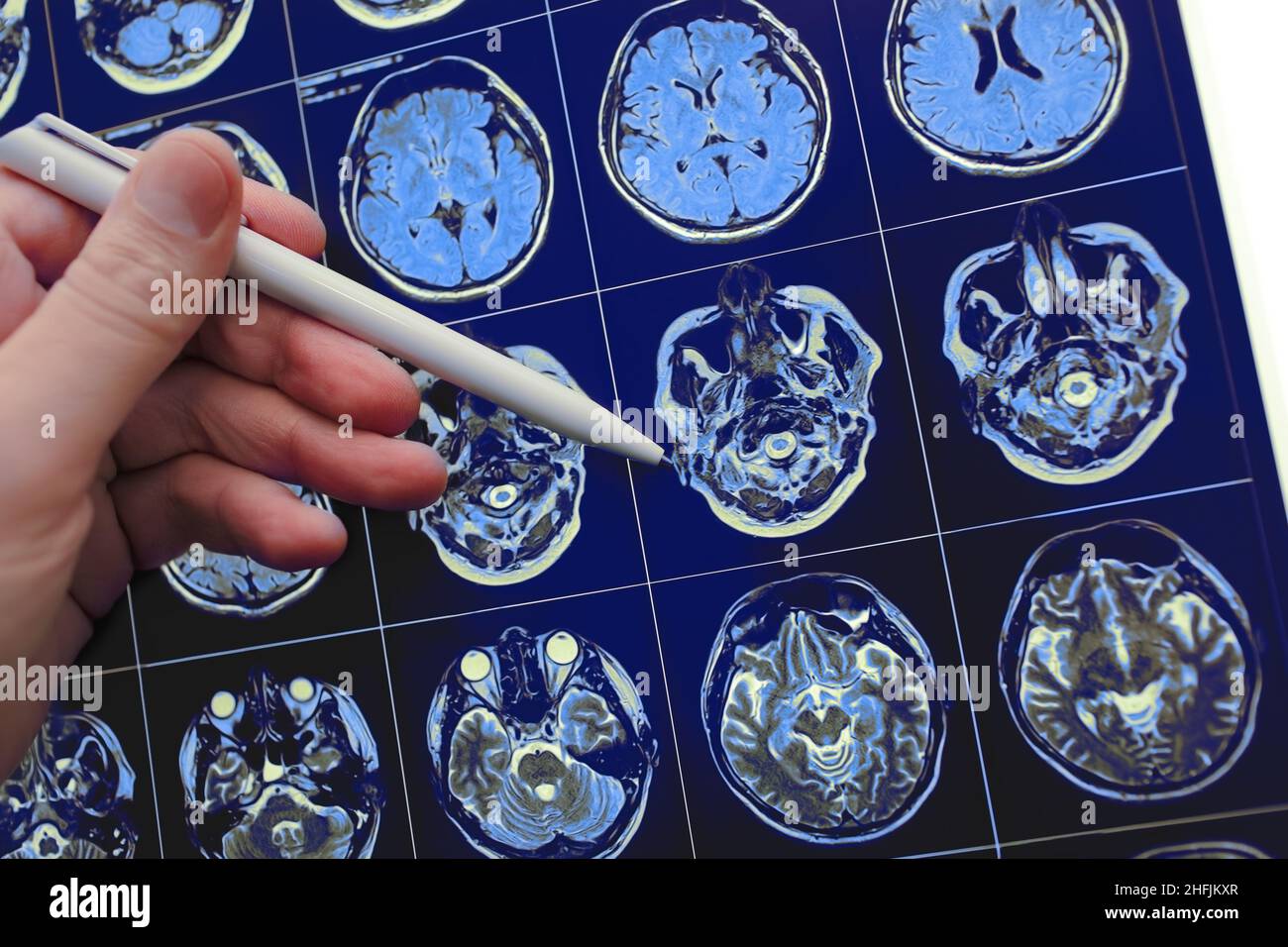 Medico che punta con la penna al poblem cerebrale sul risultato dello studio MRI. Foto Stock