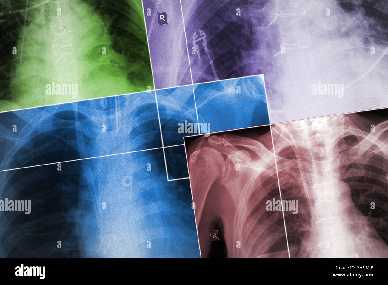 Set di immagini radiologiche dei cassoni dei pazienti nei diversi colori, sfondo medico. Foto Stock