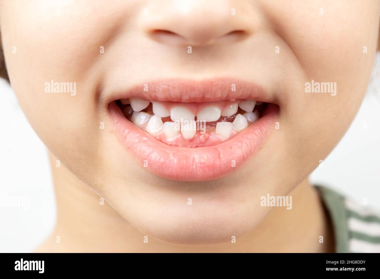 Primo piano della bocca del bambino senza un dente anteriore inferiore. Concetto di salute dentale Foto Stock