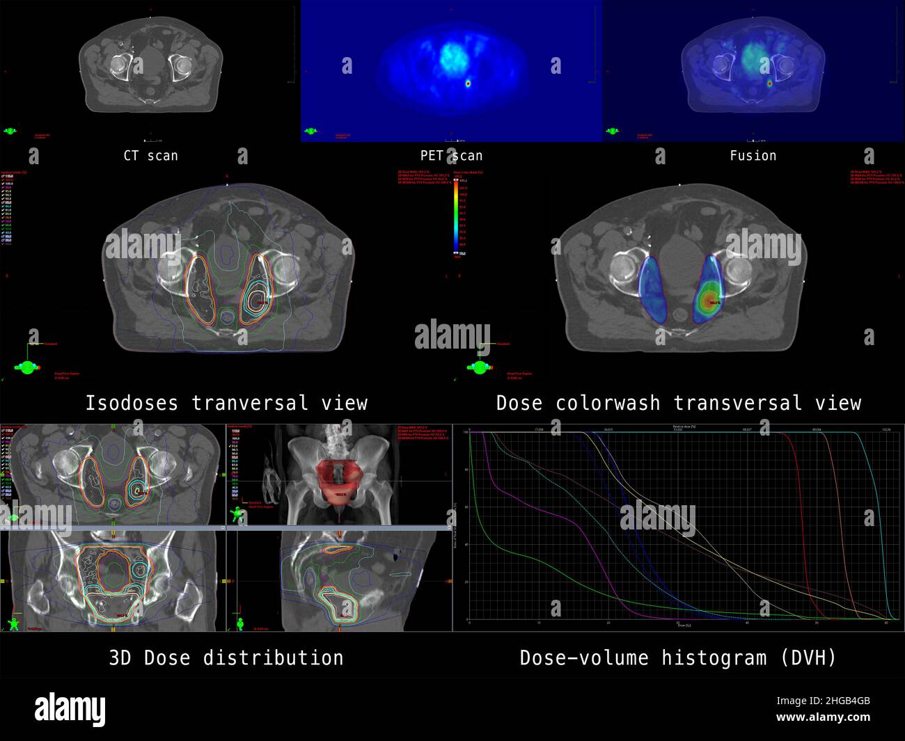 Panoramica della moderna pianificazione radiologica per la terapia del cancro della prostata con coinvolgimento dei linfonodi pelvici Foto Stock